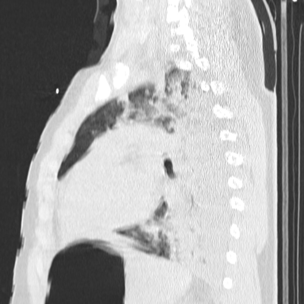 Acute aspiration pneumonitis (Radiopaedia 33605-34703 Sagittal lung window 55).jpg