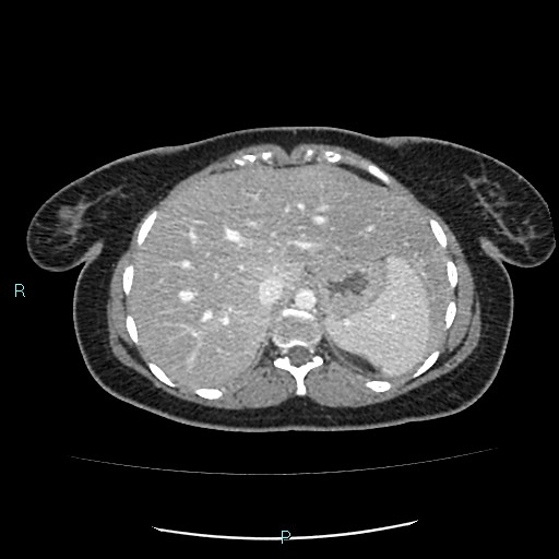 File:Acute bilateral pyelonephritis (Radiopaedia 37146-38881 Axial C+ portal venous phase 18).jpg