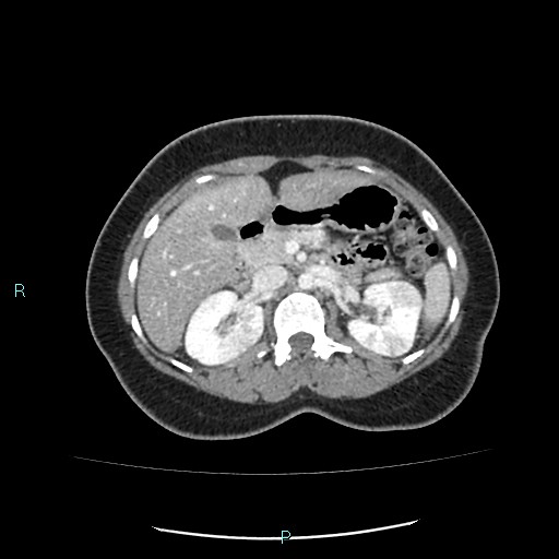 Acute bilateral pyelonephritis (Radiopaedia 37146-38881 Axial C+ portal venous phase 38).jpg