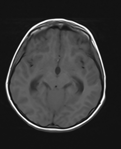 File:Acute cerebellar ataxia (Radiopaedia 61487-69446 Axial T1 10).jpg