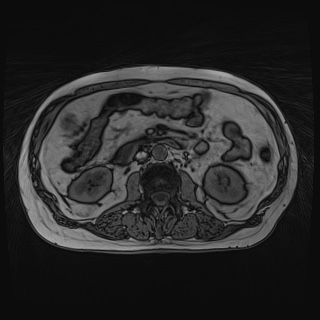 Acute cholecystitis (Radiopaedia 72392-82923 Axial T1 out-of-phase 72).jpg