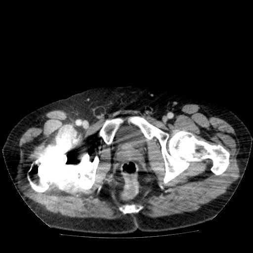 File:Acute cholecystitis and incidental left sided IVC (Radiopaedia 49352-54459 Axial C+ portal venous phase 153).jpg
