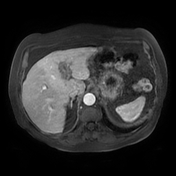File:Acute cholecystitis complicated by pylephlebitis (Radiopaedia 65782-74915 Axial arterioportal phase T1 C+ fat sat 35).jpg