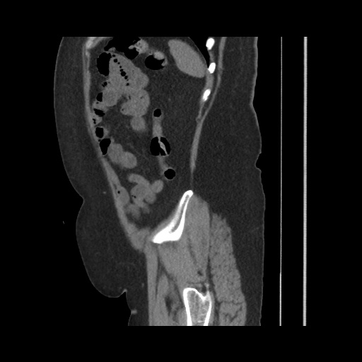 Acute cholecystitis with tensile fundus sign (Radiopaedia 71394-81723 Sagittal non-contrast 134).jpg