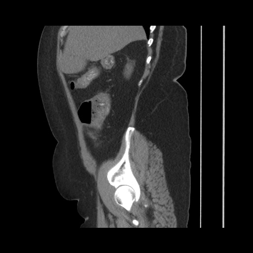 Acute cholecystitis with tensile fundus sign (Radiopaedia 71394-81723 Sagittal non-contrast 53).jpg