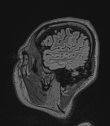 Acute disseminated encephalomyelitis (ADEM)- Anti-NMDA receptor encephalitis (Radiopaedia 54920-61201 Sagittal FLAIR 70).png