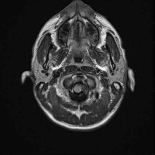 File:Acute disseminated encephalomyelitis (ADEM) (Radiopaedia 65319-74349 Axial FLAIR 2).png