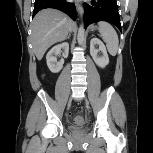 Acute diverticulitis with localized perforation (Radiopaedia 41296-44113 Coronal C+ portal venous phase 39).jpg