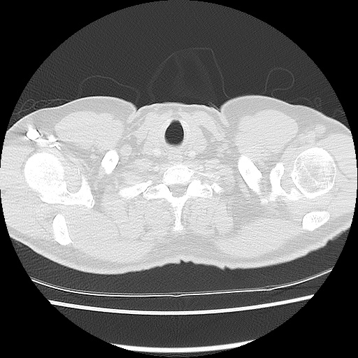 File:Acute epicardial fat necrosis (Radiopaedia 42327-45440 Axial lung window 5).jpg