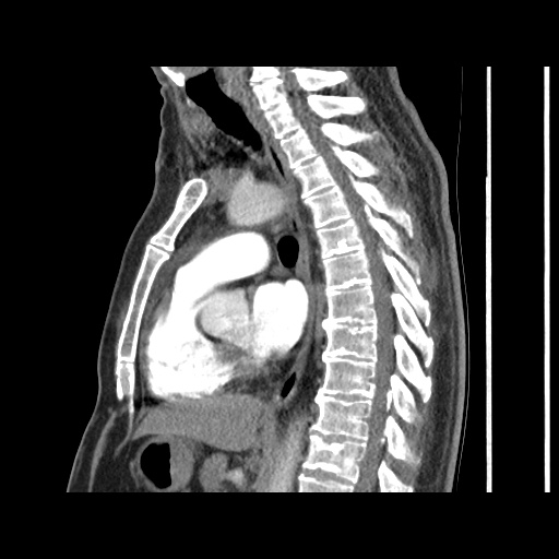 Acute epicardial fat necrosis (Radiopaedia 42327-45440 Sagittal C+ CTPA 39).jpg