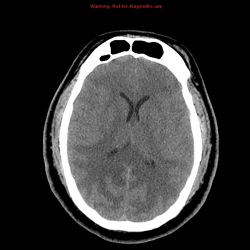 Acute hemorrhagic leukoencephalitis (Radiopaedia 14076-13920 Axial non-contrast 27).jpg
