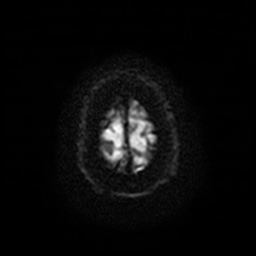 Acute internal carotid artery dissection (Radiopaedia 53541-59632 Axial DWI 29).jpg