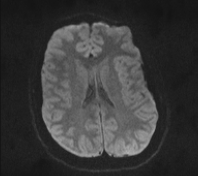 Acute ischemic stroke - posterior circulation territory (Radiopaedia 77670-89880 Axial DWI 38).jpg