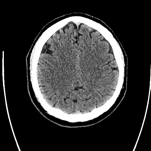 Acute left middle cerebral artery territory ischemic stroke (Radiopaedia 35688-37223 Axial non-contrast 58).png