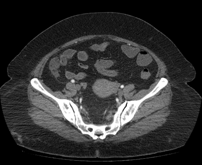Acute mesenteric ischemia (Radiopaedia 80029-93316 Axial C+ arterial phase 104).jpg