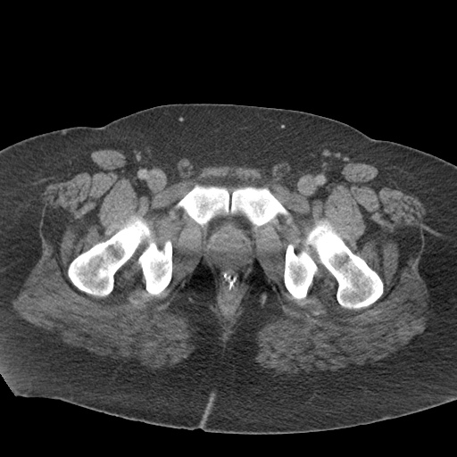 File:Acute mesenteric venous ischemia (Radiopaedia 46041-50383 Axial C+ portal venous phase 144).jpg