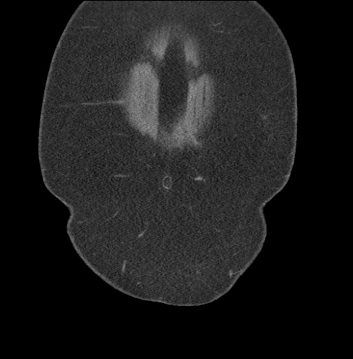 Acute mesenteric venous ischemia (Radiopaedia 46041-50383 Coronal C+ portal venous phase 6).jpg