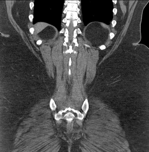 Acute mesenteric venous ischemia (Radiopaedia 46041-50383 Coronal C+ portal venous phase 82).jpg