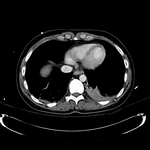 File:Acute myocardial infarction in CT (Radiopaedia 39947-42415 Axial C+ portal venous phase 12).jpg