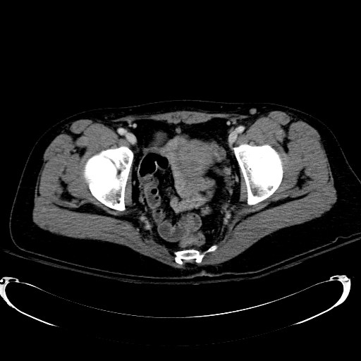 Acute myocardial infarction in CT (Radiopaedia 39947-42415 Axial C+ portal venous phase 122).jpg