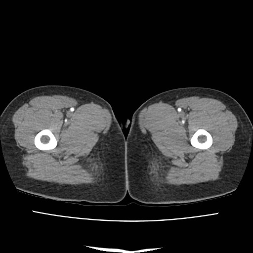 File:Acute myocarditis (Radiopaedia 55988-62613 Axial C+ portal venous phase 94).jpg