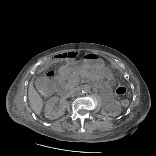 Acute on chronic pancreatitis (Radiopaedia 13233-13244 Axial non-contrast 40).jpg