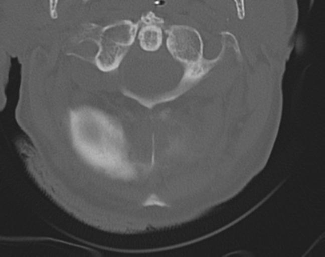 Acute on chronic subdural hematoma and thoracic vertebral injury in a multitrauma patient (Radiopaedia 31698-32619 Axial bone window 14).jpg