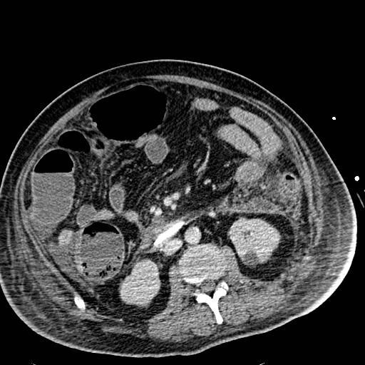 Acute pancreatic necrosis (Radiopaedia 13560-18501 Axial C+ portal venous phase 71).jpg