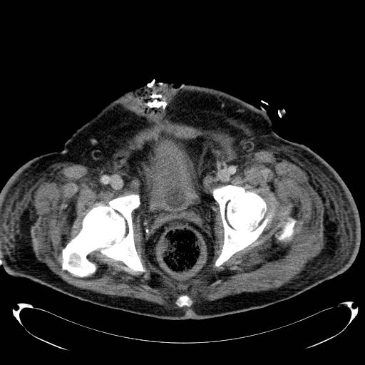 Acute pancreatic necrosis (Radiopaedia 13560-18503 Axial C+ portal venous phase 79).jpg
