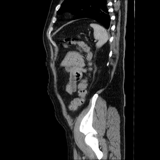 Acute pancreatitis (Radiopaedia 26663-26813 Sagittal C+ portal venous phase 62).jpg