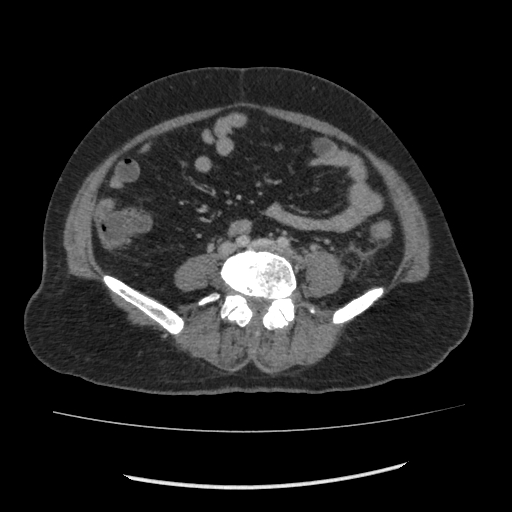 Acute pancreatitis (Radiopaedia 80007-93285 Axial C+ portal venous phase 112).jpg