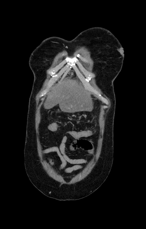 Acute pancreatitis (Radiopaedia 80007-93285 Coronal C+ portal venous phase 10).jpg