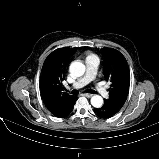 File:Acute pancreatitis (Radiopaedia 85146-100701 Axial C+ arterial phase 5).jpg