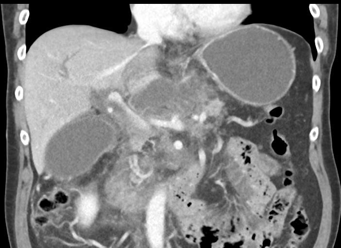 Acute pancreatitis and walled-off necrosis (Radiopaedia 29888-30404 Coronal C+ portal venous phase 26).jpg