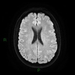 Acute posterior cerebral artery territory infarct (Radiopaedia 79329-92394 Axial DWI 18).jpg