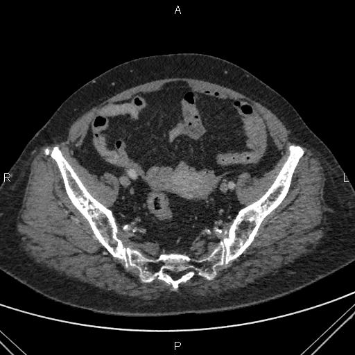 Acute renal artery occlusion (Radiopaedia 86586-102682 Axial C+ portal venous phase 80).jpg