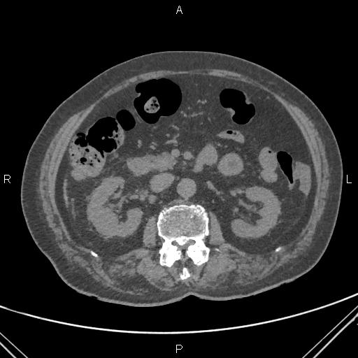 Acute renal artery occlusion (Radiopaedia 86586-102682 Axial non-contrast 32).jpg
