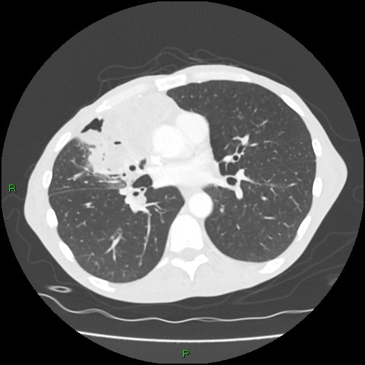 Acute right lung abscess (Radiopaedia 34806-36258 Axial lung window 102).jpg