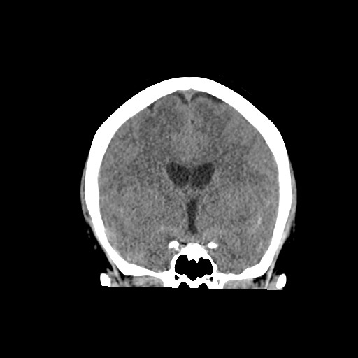 Acute subarachnoid hemorrhage and accessory anterior cerebral artery (Radiopaedia 69231-79008 Coronal non-contrast 33).jpg