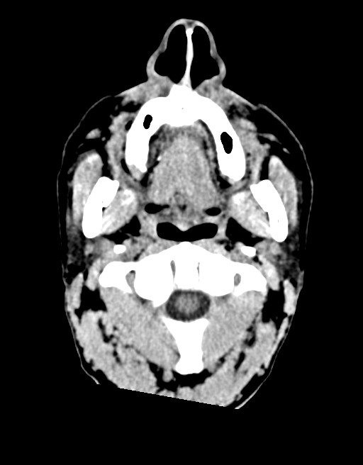 Acute superior cerebellar artery territory infarct (Radiopaedia 84104-99359 Axial non-contrast 71).jpg