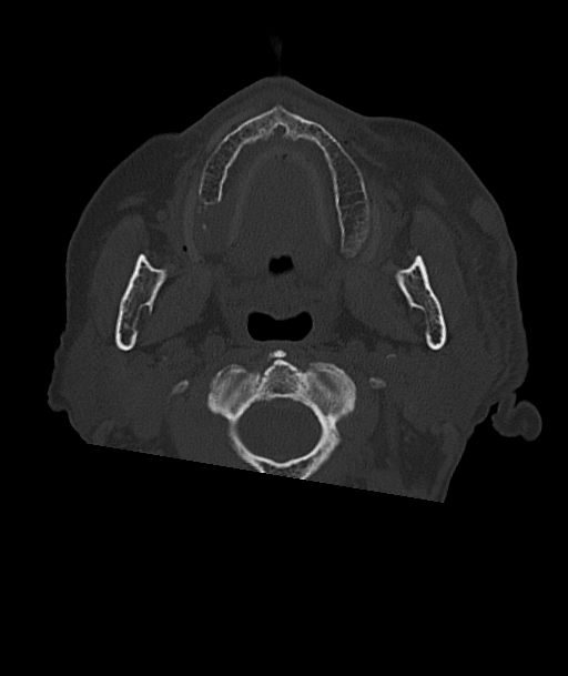 Acute traumatic subdural hematoma (Radiopaedia 82921-97257 Axial bone window 108).jpg