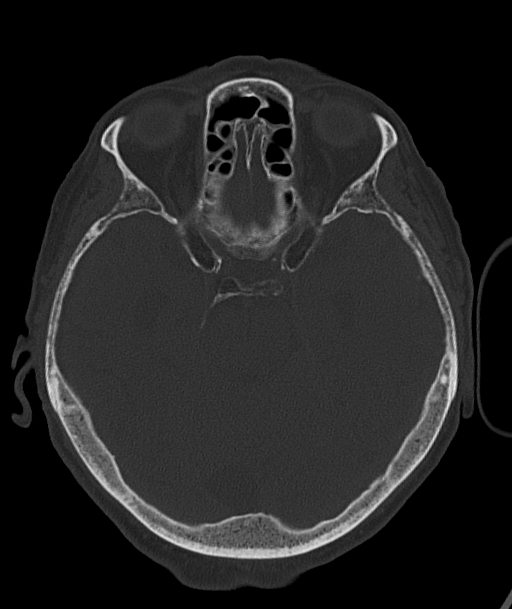 Acute traumatic subdural hematoma (Radiopaedia 82921-97257 Axial bone window 70).jpg