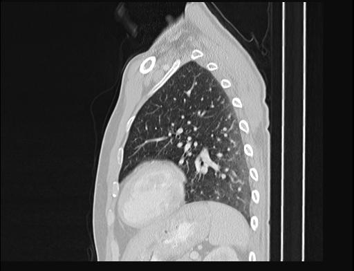 File:Addison disease (Radiopaedia 49318-54412 Sagittal lung window 17).jpg