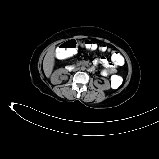 Adenocarcinoma colon with intussusception (Radiopaedia 86006-101922 Axial non-contrast 21).jpg
