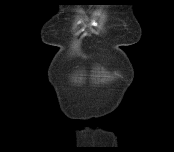 Adenocarcinoma of cecum (Radiopaedia 59222-66549 Coronal C+ arterial phase 1).jpg