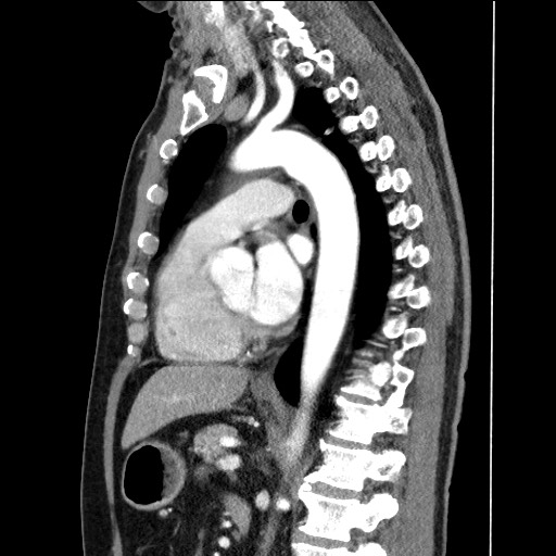 Adenocarcinoma of the lung (Radiopaedia 59871-67325 Sagittal C+ arterial phase 58).jpg