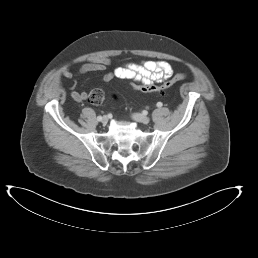 Adenocarcioma of rectum- T1 lesion (Radiopaedia 36921-38547 Axial C+ portal venous phase 67).png