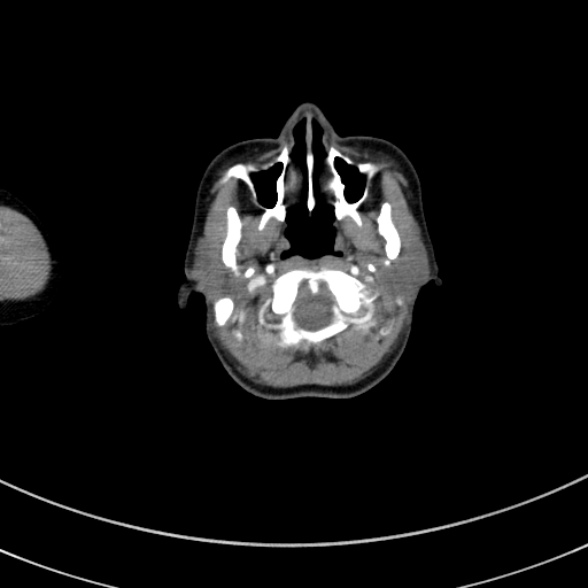 Adenocystic carcinoma of the trachea (Radiopaedia 47677-52525 Axial C+ arterial phase 6).jpg