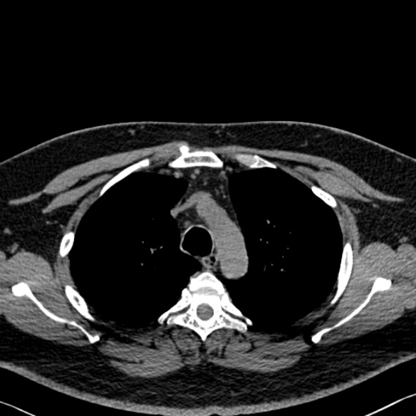 Adenoid cystic carcinoma of the trachea (Radiopaedia 49042-54137 Axial non-contrast 90).jpg