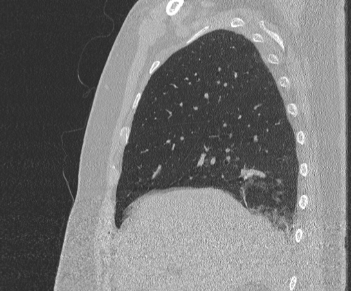 Adenoid cystic carcinoma of the trachea (Radiopaedia 49042-54137 Sagittal lung window 129).jpg